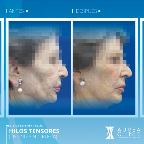 Hilos tensores